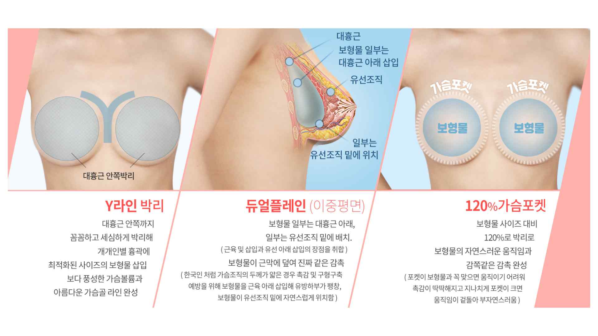 隆乳假體位置示意,桃園隆乳診所,隆乳手術假體