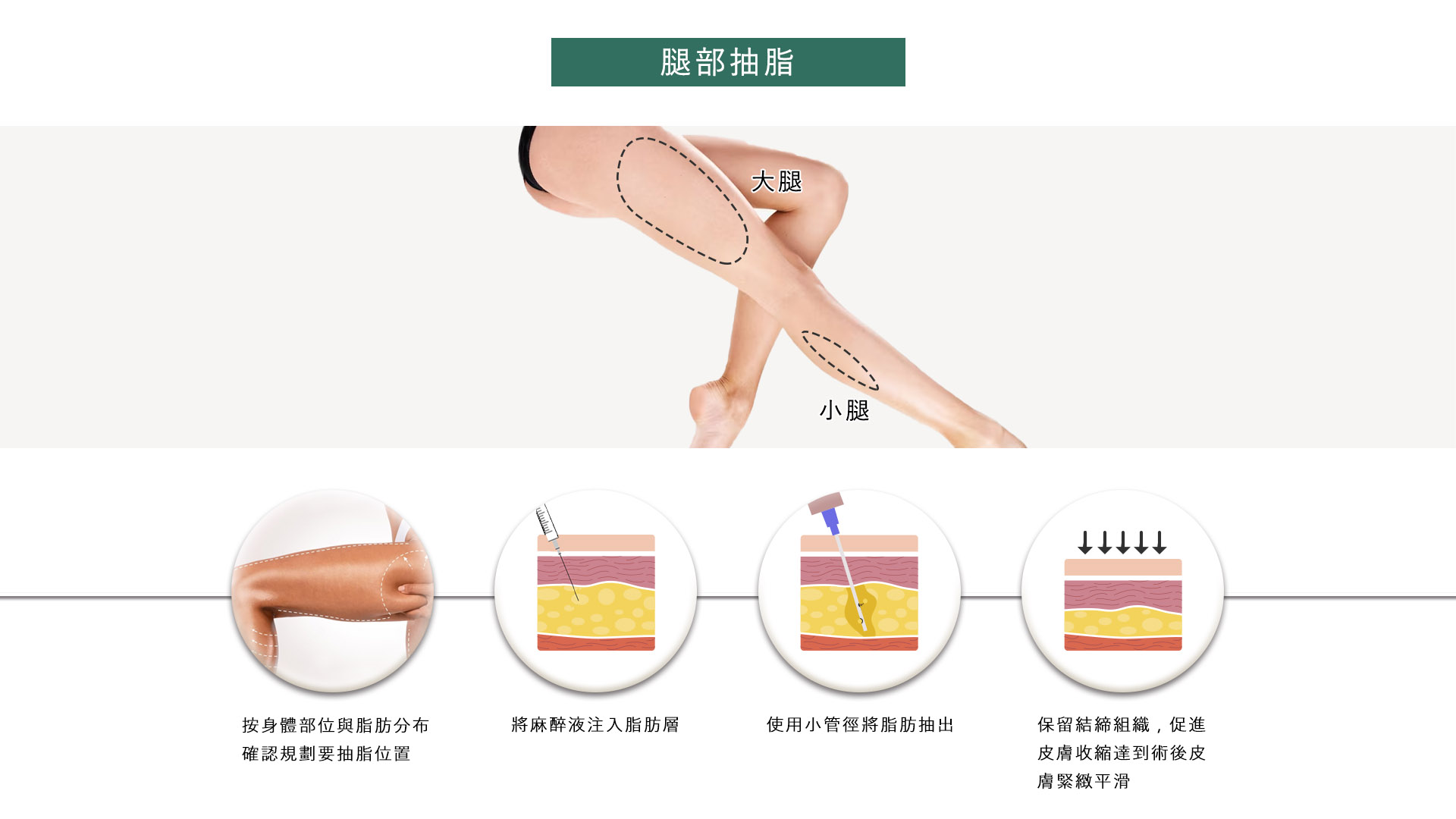 桃園抽脂手術_永恆醫美