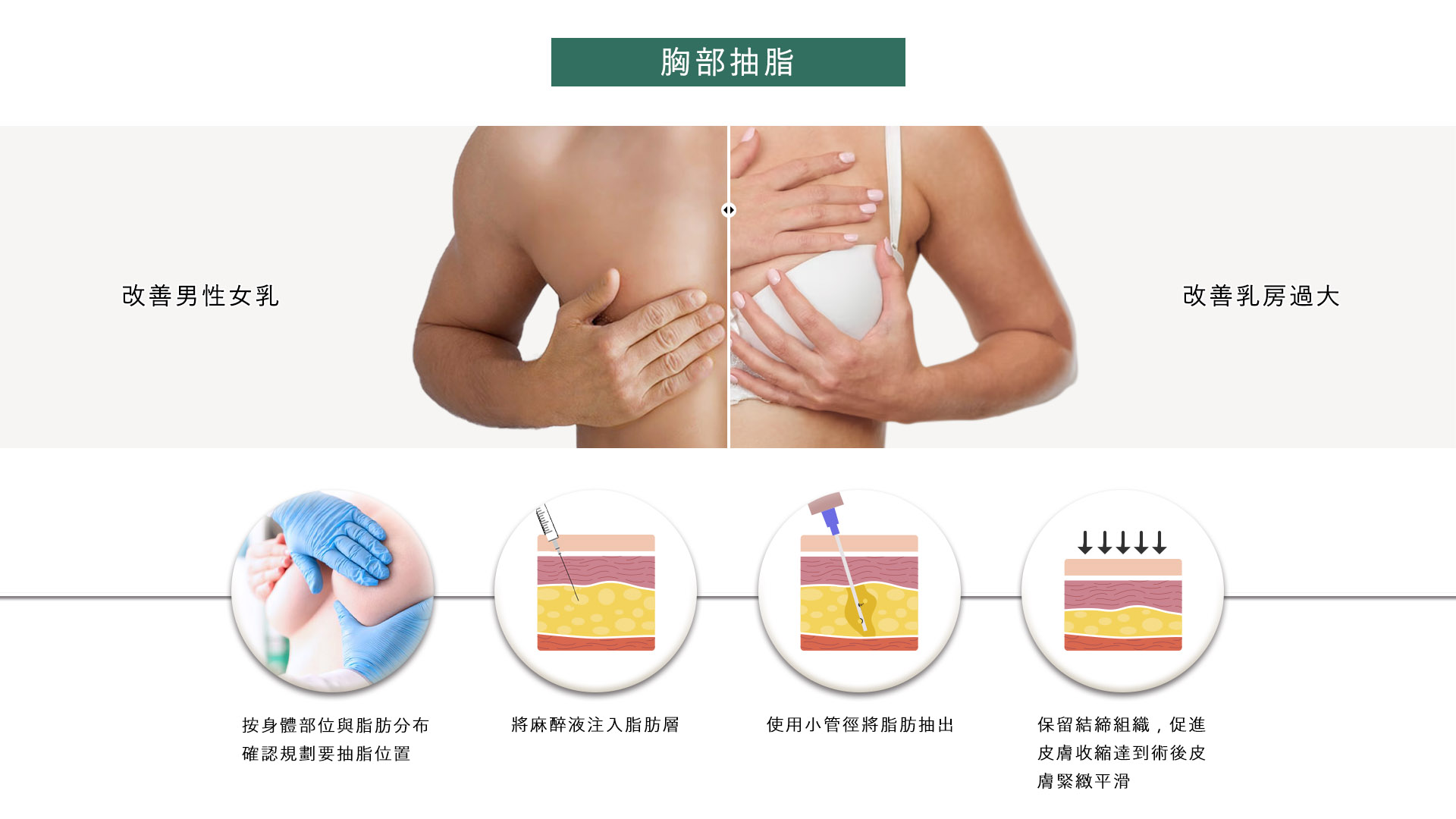 桃園抽脂手術_永恆醫美