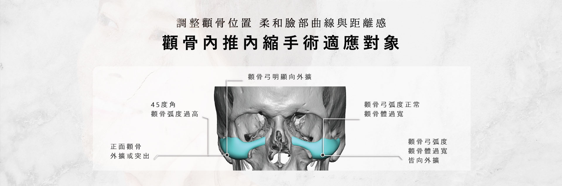 台南桃園削骨手術,台南桃園顴骨內推,台南桃園下顎骨角削骨,台南桃園下巴截骨