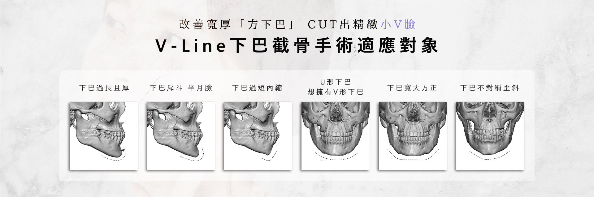 台南桃園削骨手術,台南桃園顴骨內推,台南桃園下顎骨角削骨,台南桃園下巴截骨