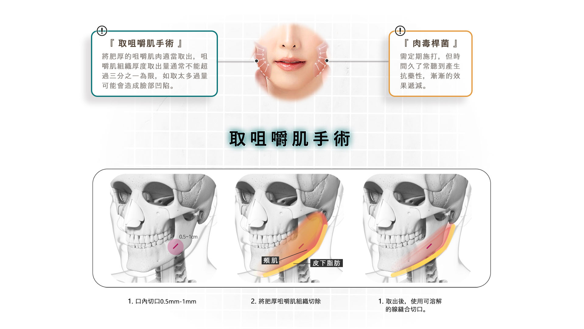 台南桃園削骨手術,台南桃園顴骨內推,台南桃園下顎骨角削骨,台南桃園下巴截骨