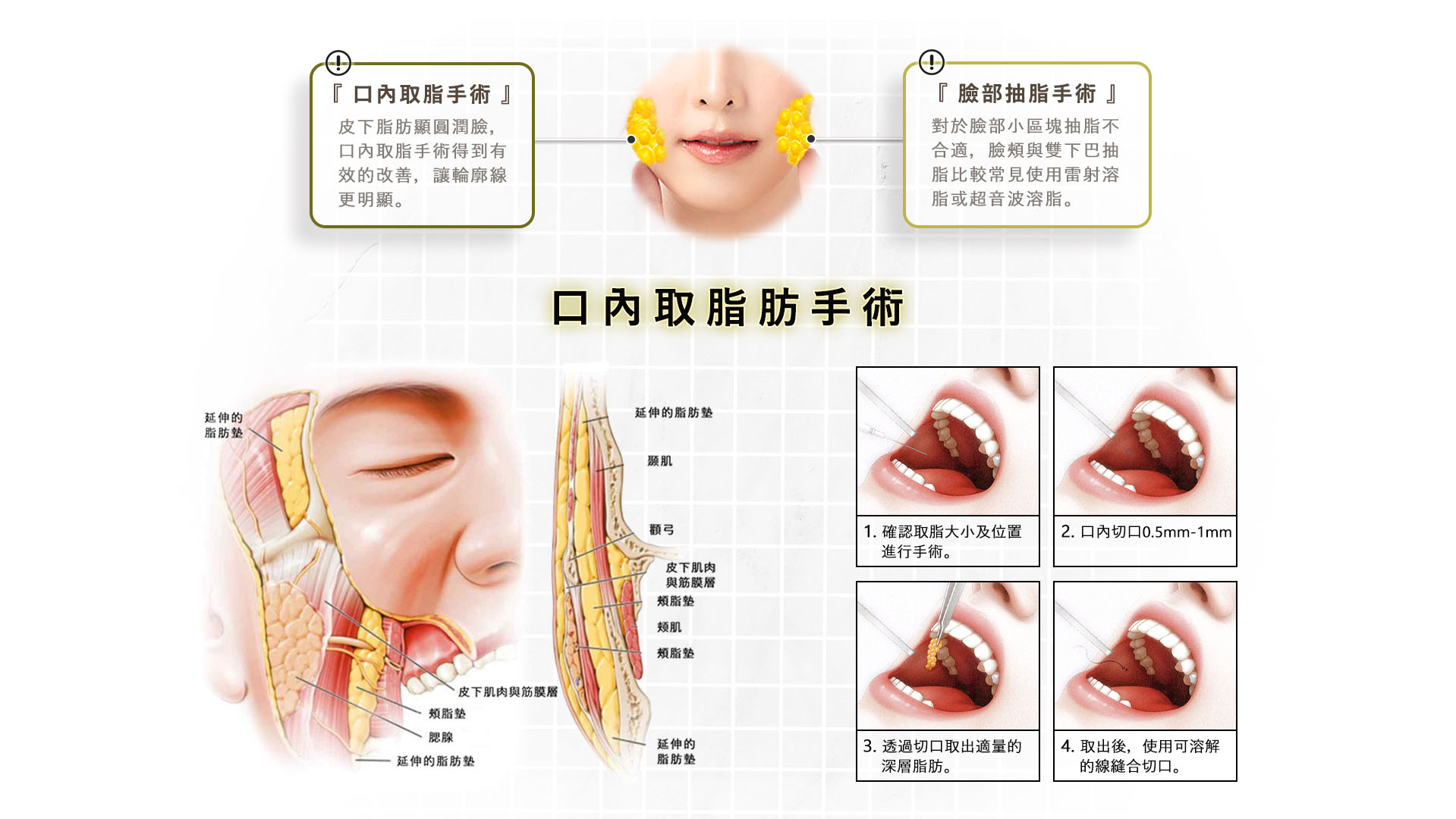 台南桃園削骨手術,台南桃園顴骨內推,台南桃園下顎骨角削骨,台南桃園下巴截骨