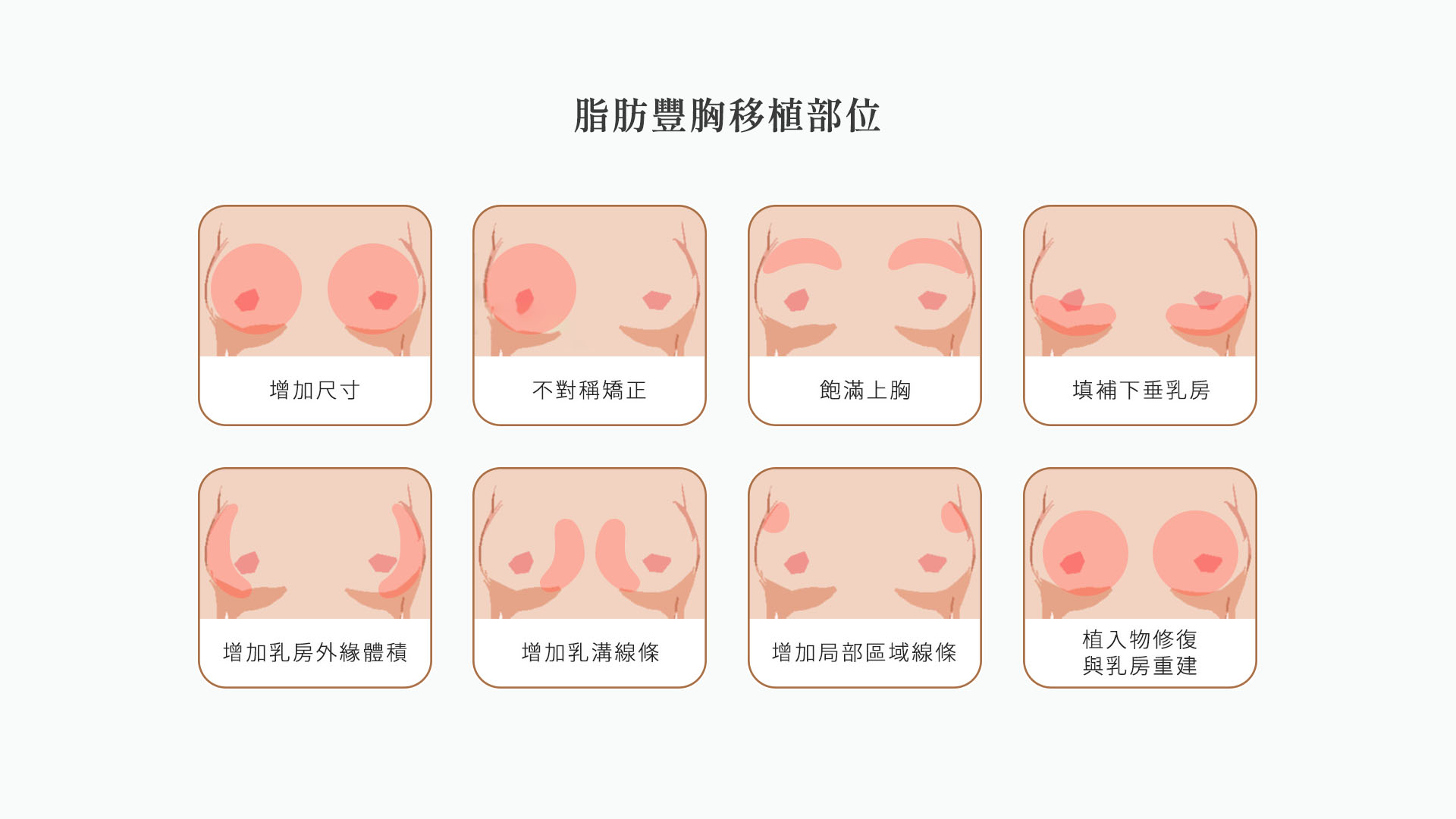 自體脂肪隆乳移植部位?_自體脂肪隆乳