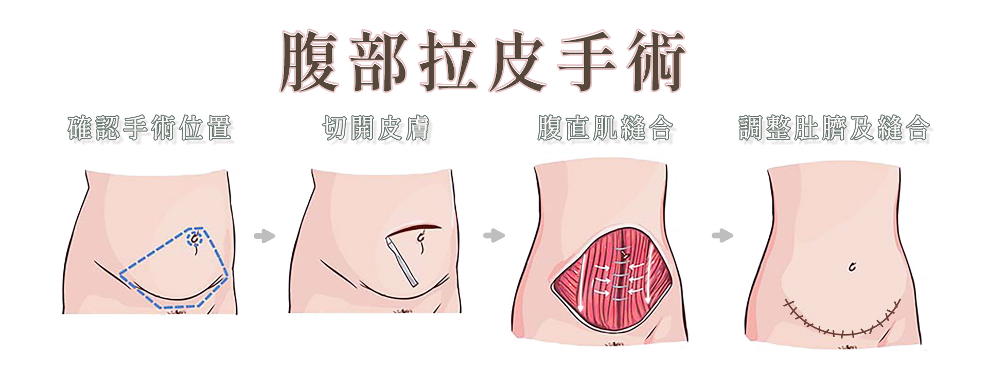 桃園腹部拉皮權威醫師推薦價格費用003