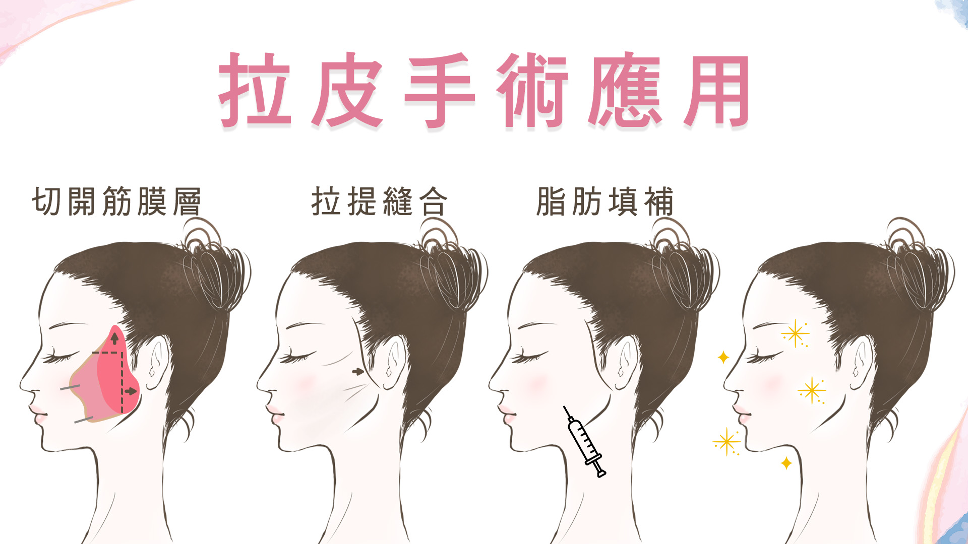 高臉部拉皮手術權威醫師推薦