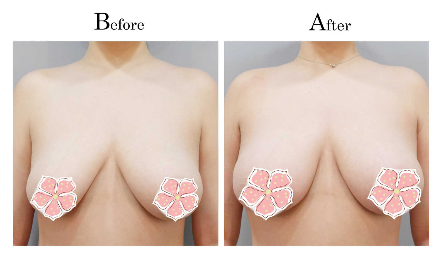 桃園自體脂肪隆乳案例A_自體脂肪隆乳