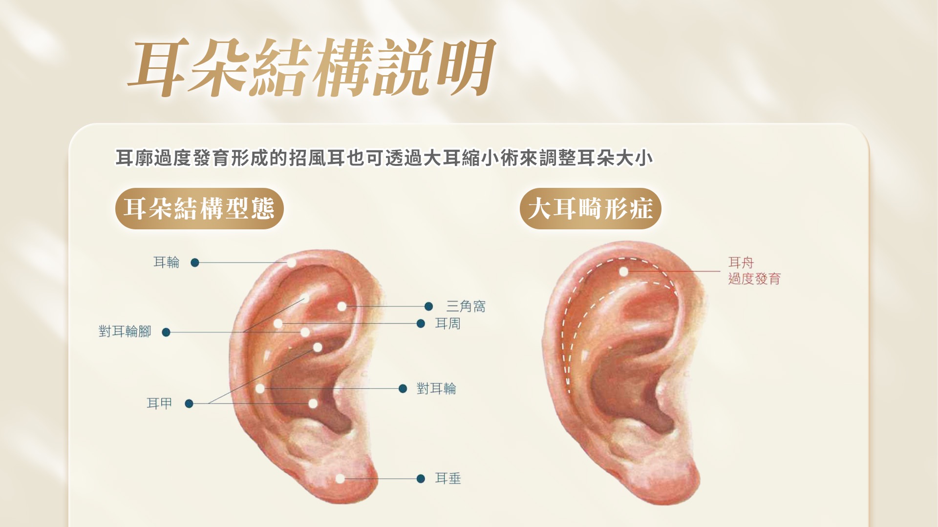 桃園耳朵整形招風耳.大耳縮.小耳垂修復形狀改善價格費用權威醫師推薦18
