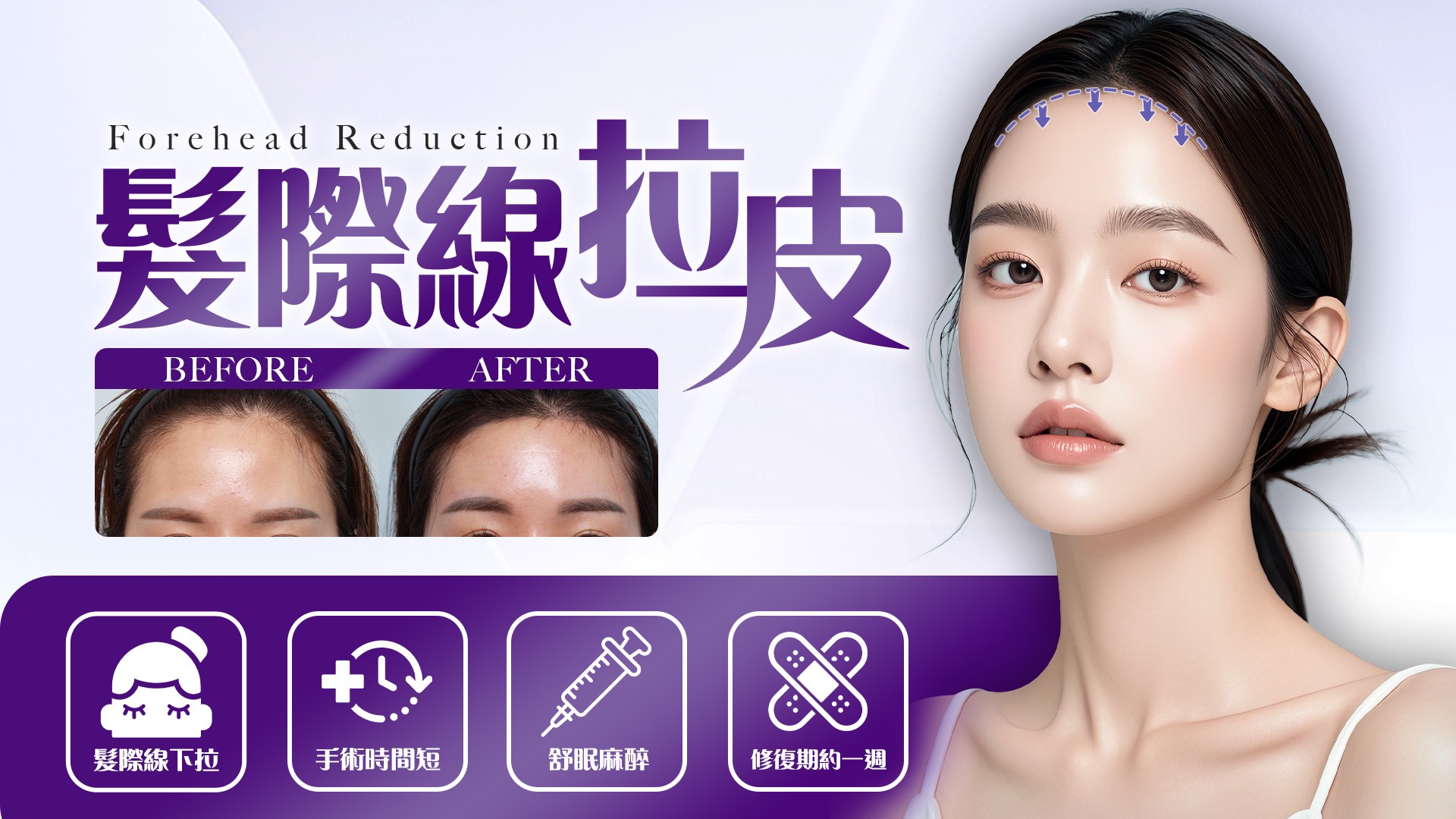 桃園髮際線拉皮改善額頭高問題權威醫師推薦價格費用01