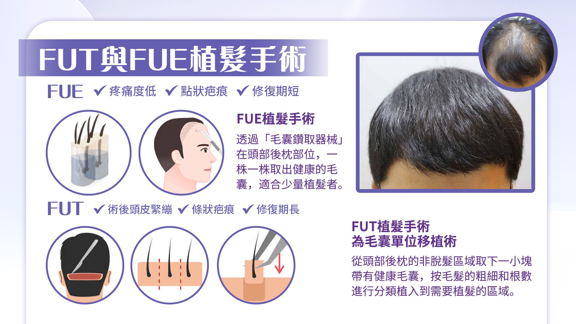 桃園髮際線拉皮改善額頭高問題權威醫師推薦價格費用07