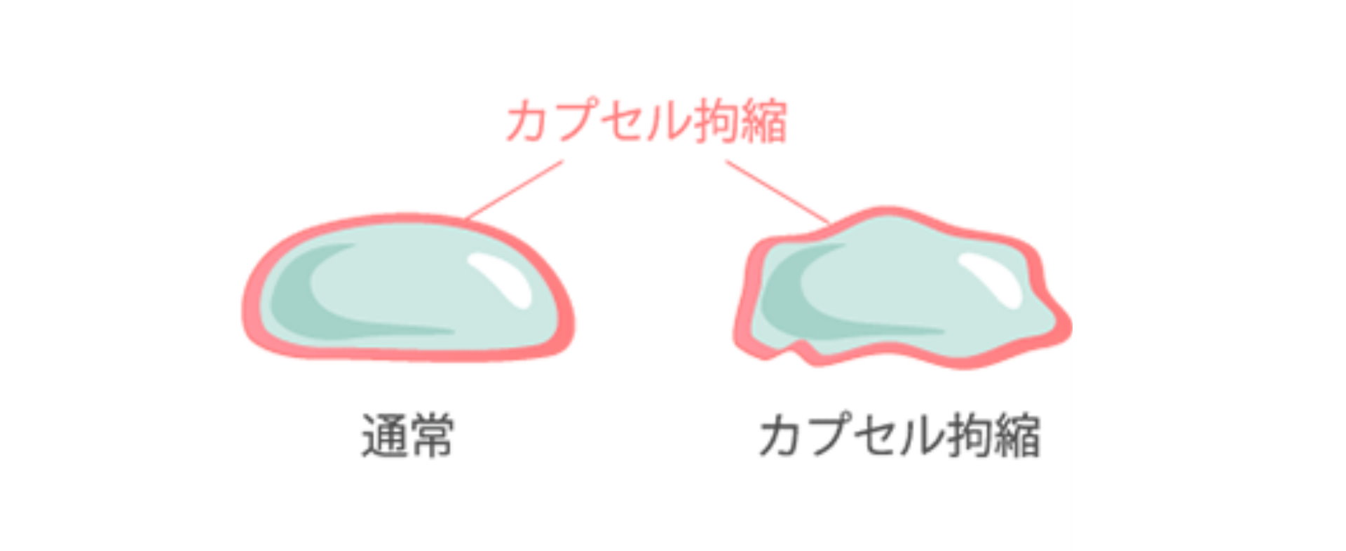 桃園隆乳失敗問題假體破裂Dr.邱智弘醫師隆乳權威能重建