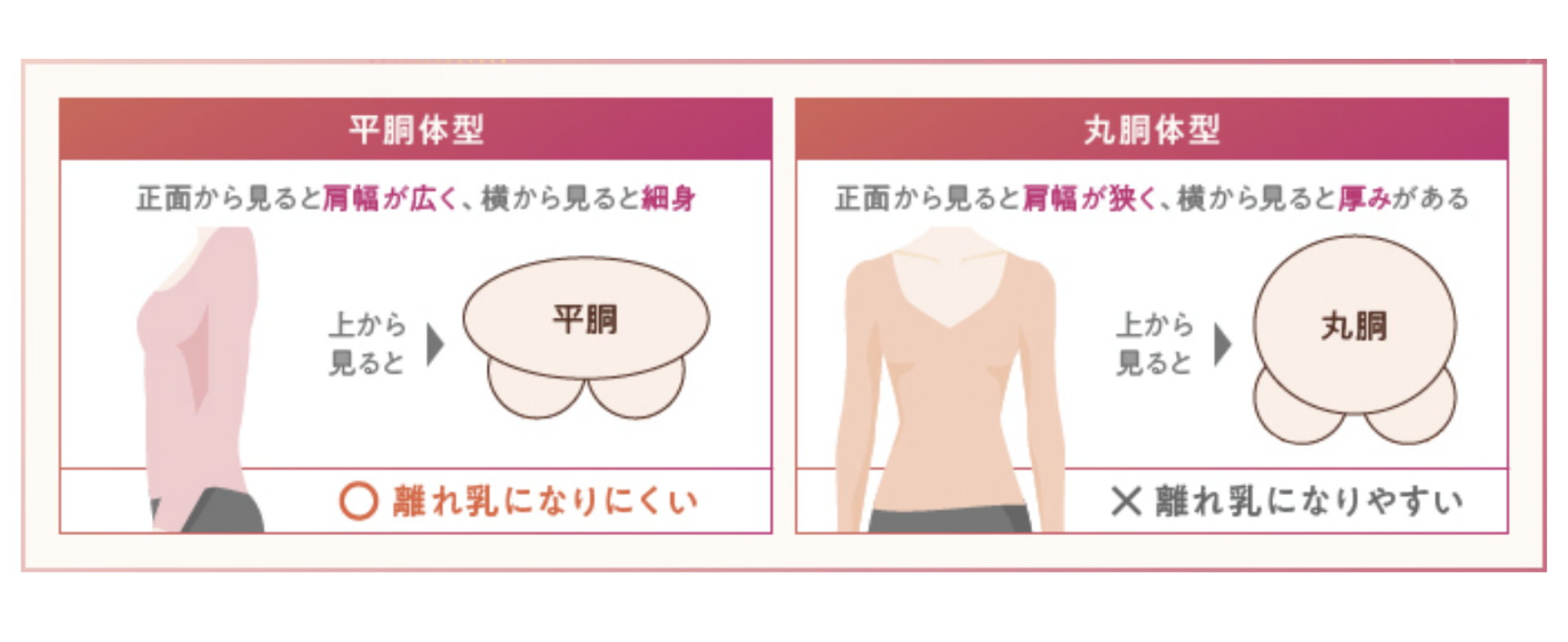 桃園隆乳失敗問題胸部分太開或太近Dr.邱智弘醫師隆乳權威能重建